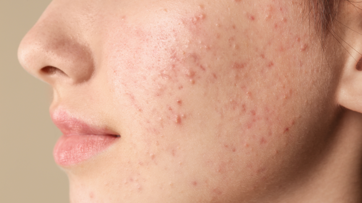 Acne Treatment